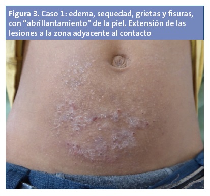 Figura 2. Caso 2: detalle de lesiones: liquenificación y engrosamiento de la piel de tipo granulomatoso por exposición prolongada