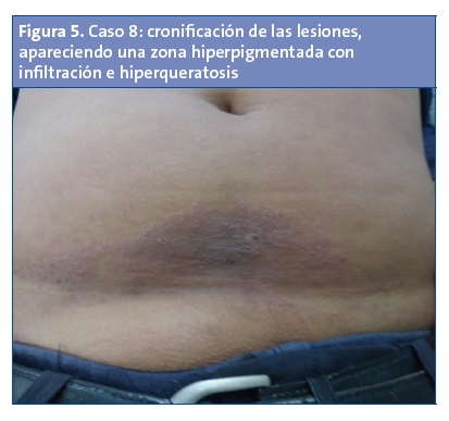 Figura 5. Caso 8: cronificación de las lesiones, apareciendo una zona hiperpigmentada con infiltración e hiperqueratosis