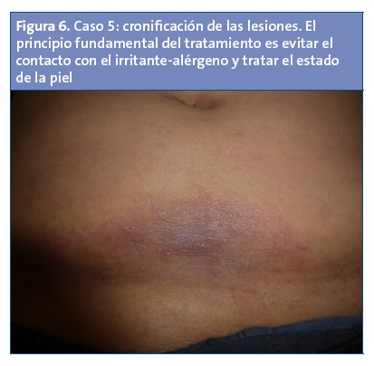 Figura 6. Caso 5: cronificación de las lesiones. El principio fundamental del tratamiento es evitar el contacto con el irritante-alérgeno y tratar el estado de la piel