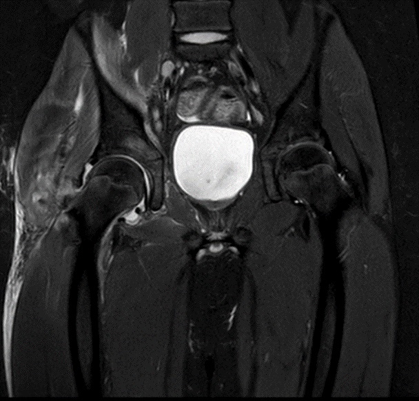 Figura 2. Resonancia magnética de caderas: aumento de señal por engrosamiento sinovial y afectación acetabular derecha con edema que se extiende hacia la rama iliopubiana y los músculos obturadores y psoas ilíaco-ipsilaterales