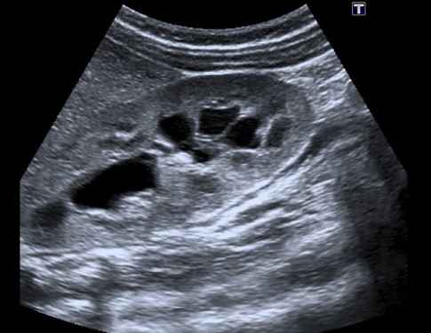 Figura 1. Dilatación uretero-pielo-calicial