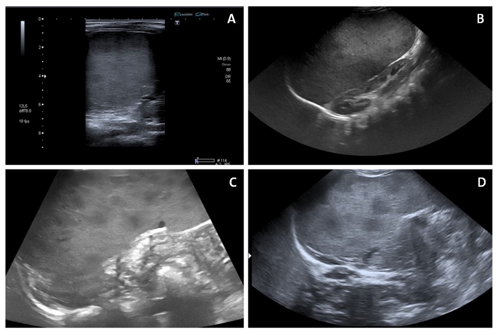 Figura 1. A, C y D: esplenomegalia con múltiples lesiones hipoecoicas subcentimétricas compatibles con nódulos esplénicos. B: esplenomegalia masiva que aplasta al riñón.
