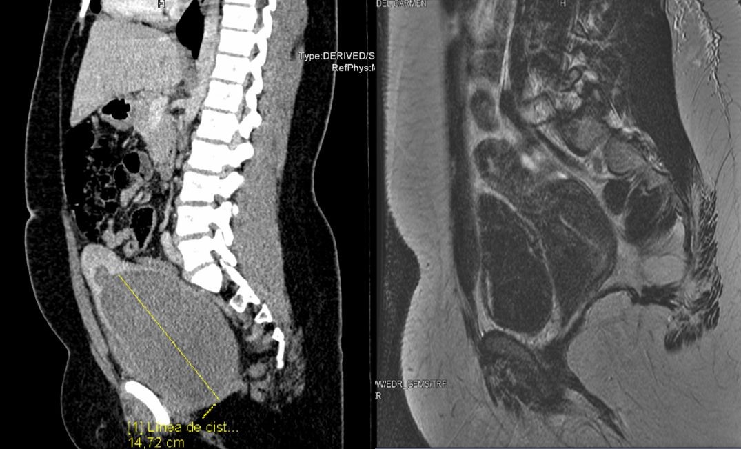 Figura 1. Tomografía computarizada (a la izquierda) y resonancia magnética (a la derecha) de la paciente