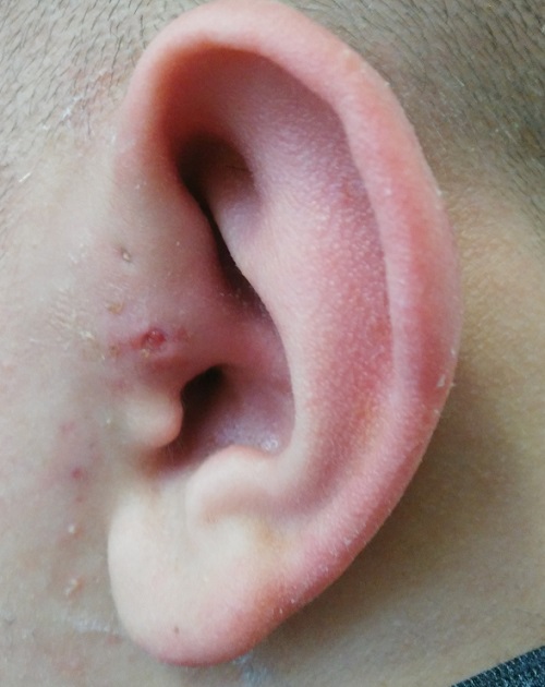 Figura 2. Región preauricular y pabellón auricular tras la intervención quirúrgica