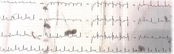 Figura 1. Electrocardiograma (3 días de vida): ritmo sinusal con PR largo (240 msg)