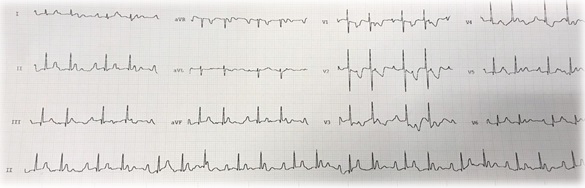Figura 2. Electrocardiograma (7 días de vida): ritmo sinusal con PR largo (240 msg) y bloqueo de 2.º grado Mobitz I o Wenckebach