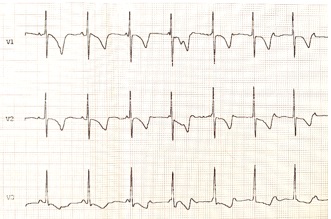Figura 3. Electrocardiograma actual: BAV de tercer grado