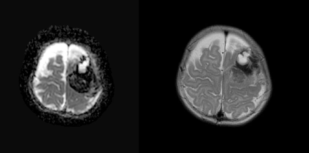 Figura 1. Imagen de resonancia magnética cerebral al ingreso