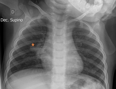 Figura 1. Radiografía de tórax en la que se observa atresia bronquial derecha con sospecha de broncocele