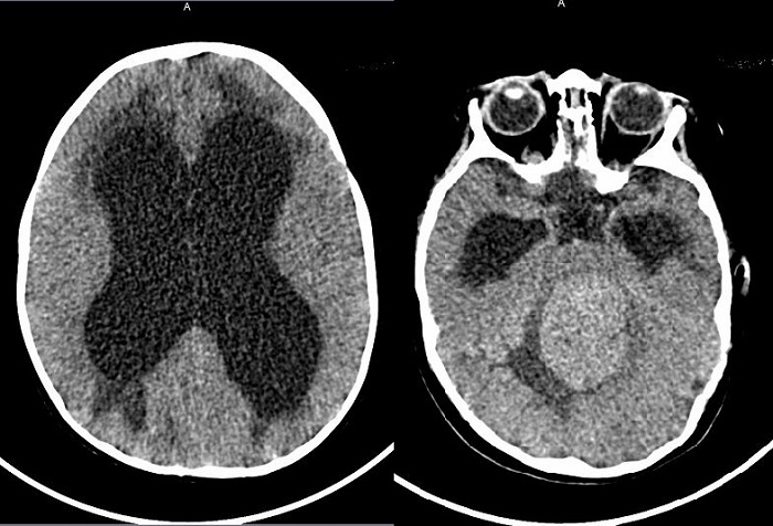 Figura 1. Tomografía computarizada craneal. Tumoración en fosa posterior con hidrocefalia triventricular grave