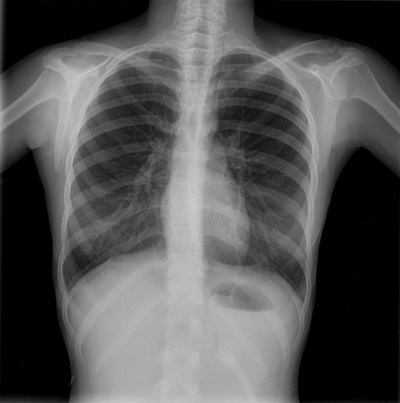 Figure 4. Case 6. Female adolescent aged 15 years that presented to the emergency department with severe epigastric pain of 24 hours’ duration associated with nausea without vomiting, diarrhoea or fever. The diagnosis was made by chest radiograph, which was indicated on account of onset of fever 24 hours after performance of an upper endoscopy