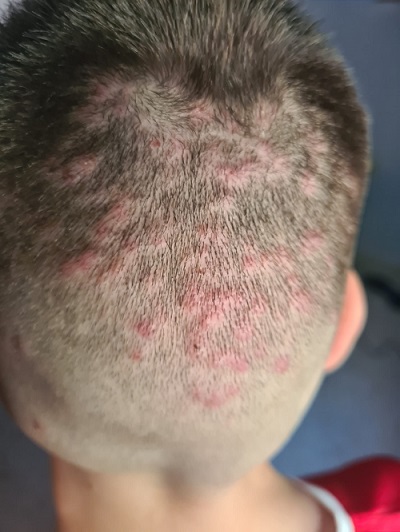 Figura 1. Lesiones papulosas y pustulosas, eritematosas, en el cuero cabelludo, agrupadas en la región occipital