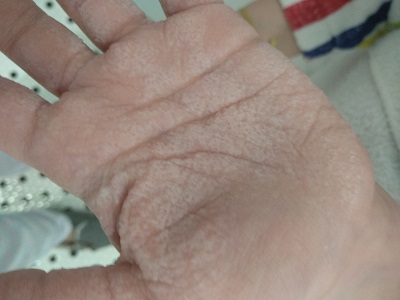 Figura 1. Mano izquierda del paciente: maceración dérmica, dermatoglifos acentuados tras contacto con el agua