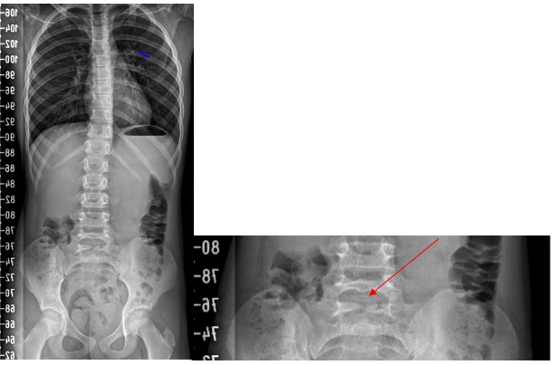 Figura 1. A la izquierda, radiografía de columna completa. A la derecha, imagen ampliada donde se visualiza raquisquisis a nivel de S1.