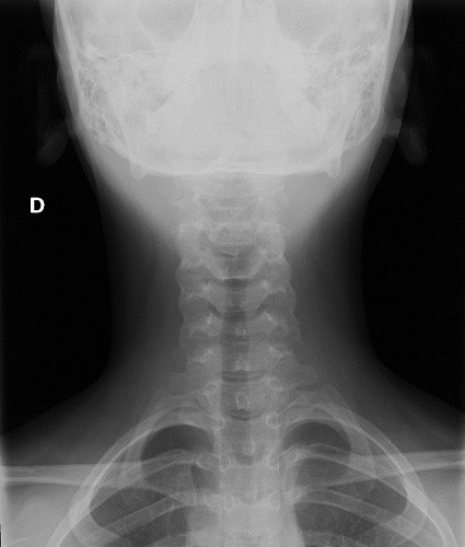 Figura 2. Radiografía cervical con el cabello recogido