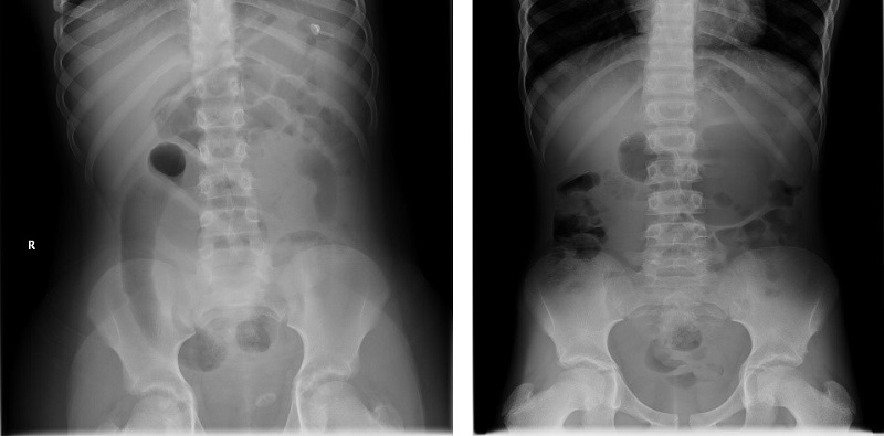 Figura 1. Radiografía abdominal (caso 1 y 2): signos de obstrucción intestinal a distintos niveles. Patrón de aireación anómalo, sugestivo de obstrucción intestinal
