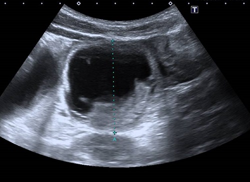 Figura 2. Fibrosis quística y síndrome de obstrucción intestinal distal. Detalle de un asa dilatada de intestino delgado (5 cm), con contenido denso en su parte inferior.