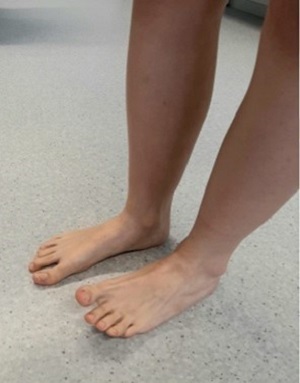 Figura 1. Imposibilidad de dorsiflexión (pie derecho).