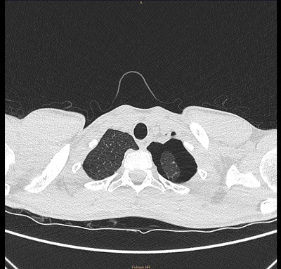 Figura 2.  Imagen de TC de tórax sin contraste. Neumotórax izquierdo. Bullas subpleurales en ambas regiones apicales de los pulmones, sin signos de neumotórax derecho.