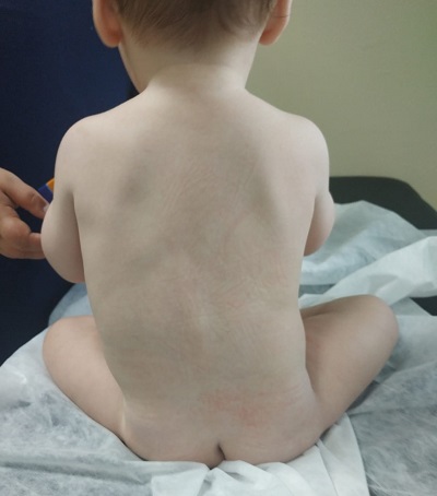 Figura 1. Escoliosis dorsal izquierda a los 7 meses de edad.