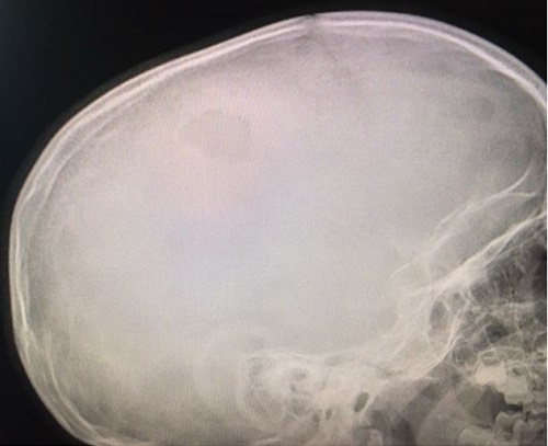 Figura 1. Radiografía lateral de cráneo
