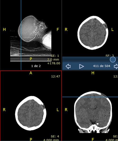 Figura 2. Tomografía axial computarizada craneal sin contraste