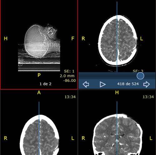 Figura 3. Tomografía axial computarizada cerebral con contraste