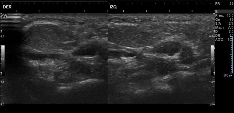 Figura 3. Lesiones hipoecoicas en cada pie, con ecoestructura similar a la grasa cutánea subyacente