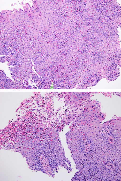 Figuras 1 y 2. Biopsias previas al tratamiento con dupilumab. El punteado rojizo corresponde a un infiltrado eosinofílico significativo