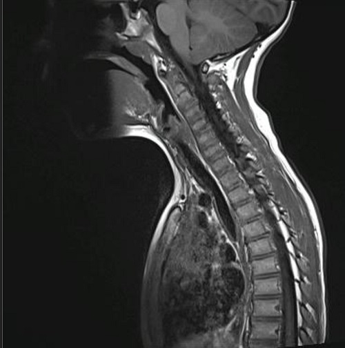 Figura 5. Resonancia magnética nuclear vertebral