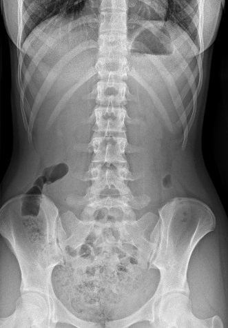 Figura 1. Paciente de 14 años con dolor lumbar. Radiografía de columna anteroposterior en bidipestación con “sacralización” de L5. 