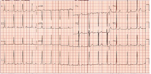 Figura 1. Síndrome de WPW (PR corto y onda delta al inicio del QRS)