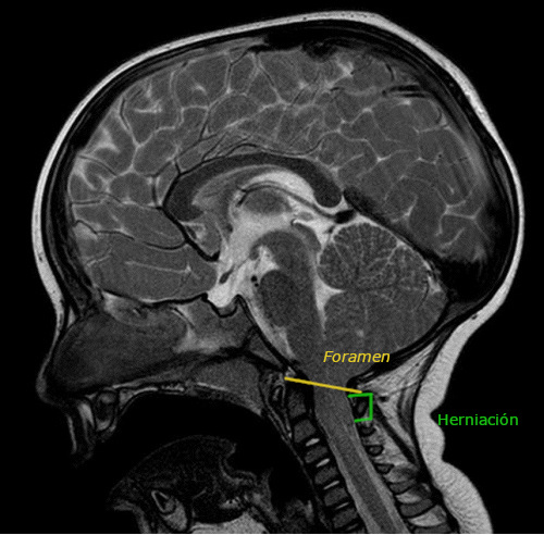Figura 1. Corte sagital de resonancia magnética nuclear donde se objetiva herniación de amígdalas cerebelosas