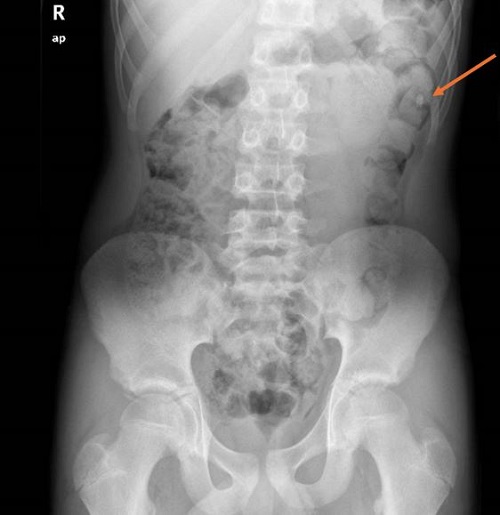 Figura 1. Imagen radiodensa en ángulo esplénico del colon. Abundantes restos fecales. No dilatación de asas de ID que sugieran cuadro obstructivo