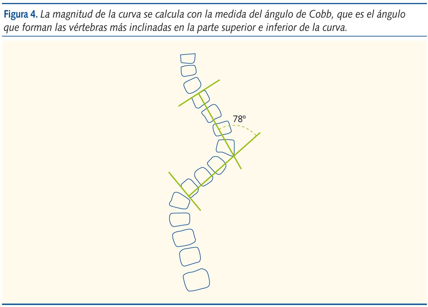 Figura 4. La magnitud de la curva se calcula con la medida del ángulo de Cobb, que es el ángulo que forman las vértebras más inclinadas en la parte superior e inferior de la curva.