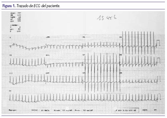 Trazado de ECG del paciente