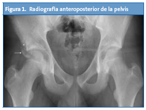 Figura 1. Radiografía anteroposterior de la pelvis