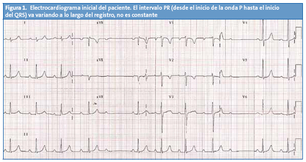 Figura 1. Electrocardiograma inicial del paciente. El intervalo PR (desde el inicio de la onda P hasta el inicio del QRS) va variando a lo largo del registro, no es constante