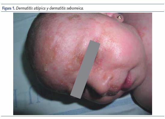 Dermatitis atópica y dermatitis seborreica