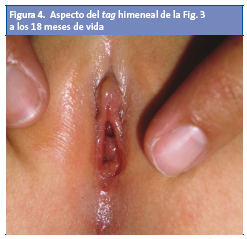 Figura 4. Aspecto del tag himeneal de la Fig. 3 a los 18 meses de vida