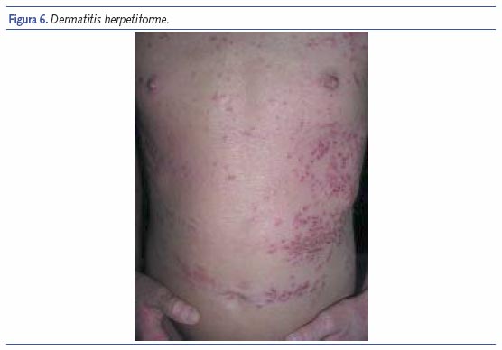 Dermatitis herpetiforme
