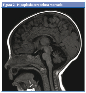 Figura 2. Hipoplasia cerebelosa marcada