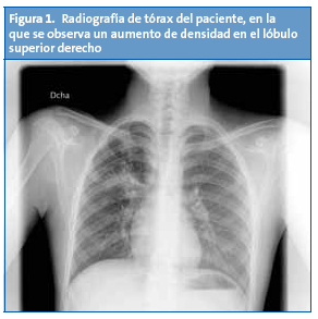 Figura 1. Radiografía de tórax del paciente, en la que se observa un aumento de densidad en el lóbulo superior derecho