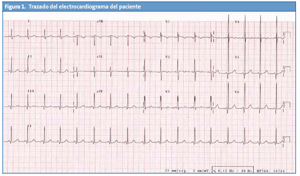 Figura 1. Trazado del electrocardiograma del paciente