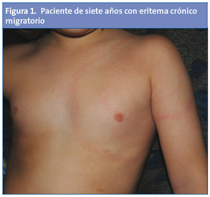 	Figura 1. Paciente de siete años con eritema crónico migratorio