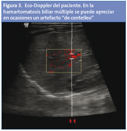 Figura 3. Eco-Doppler del paciente. En la hamartomatosis biliar múltiple se puede apreciar en ocasiones un artefacto “de centelleo”