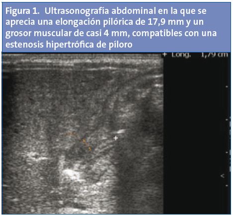 Figura 1. Ultrasonografía abdominal en la que se aprecia una elongación pilórica de 17,9 mm y un grosor muscular de casi 4 mm, compatibles con una estenosis hipertrófica de píloro