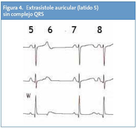 Figura 4. Extrasístole auricular (latido 5) sin complejo QRS
