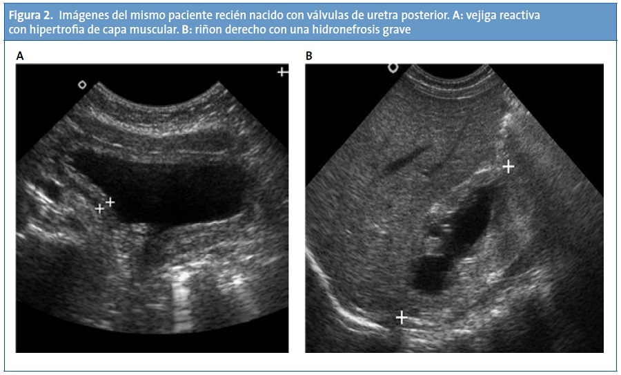 Figura 2. Imágenes del mismo paciente recién nacido con válvulas de uretra posterior. A: vejiga reactiva con hipertrofia de capa muscular. B: riñon derecho con una hidronefrosis grave