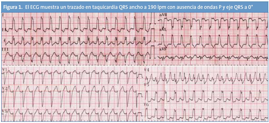 Figura 1. El ECG muestra un trazado en taquicardia QRS ancho a 190 lpm con ausencia de ondas P y eje QRS a 0°